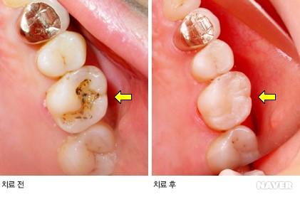 치료전 치료후의 치아 사진입니다.